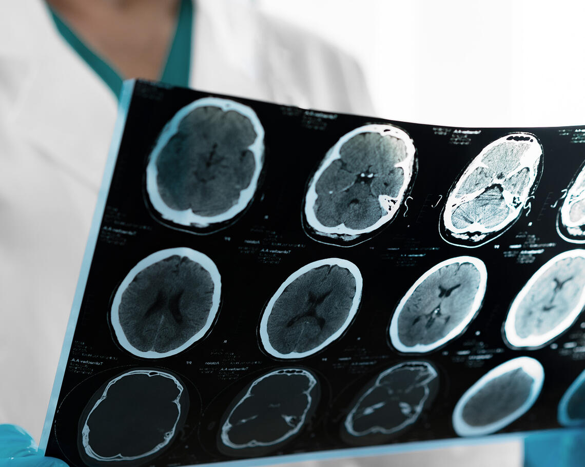 A clinician is holding an MRI film showing various views of a brain.